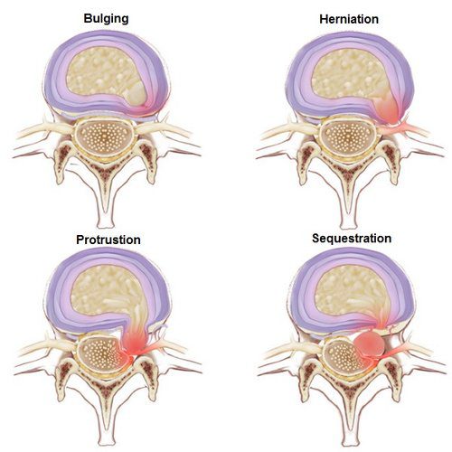 Stages of Herniated Disc