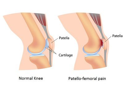 Patellofemoral Pain Runners Knee