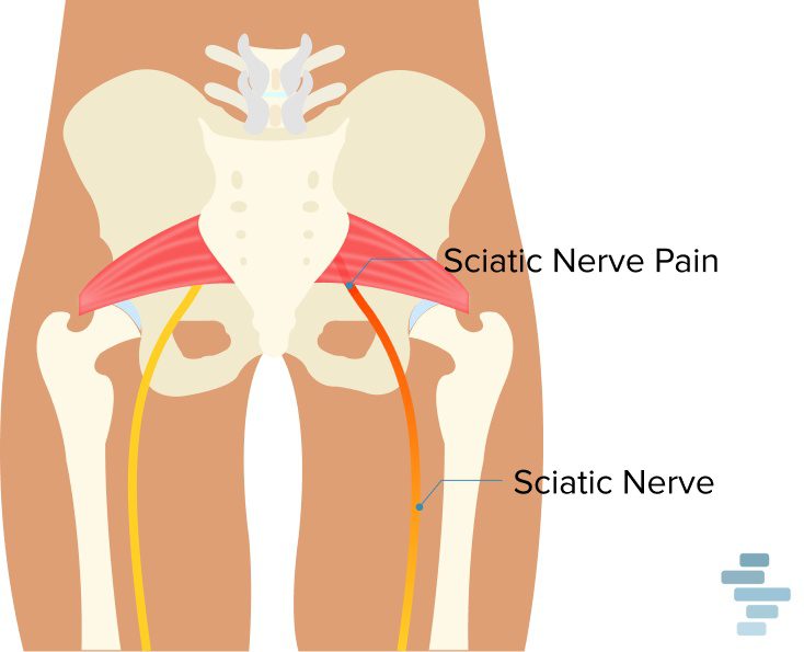 sciatica nerve pain